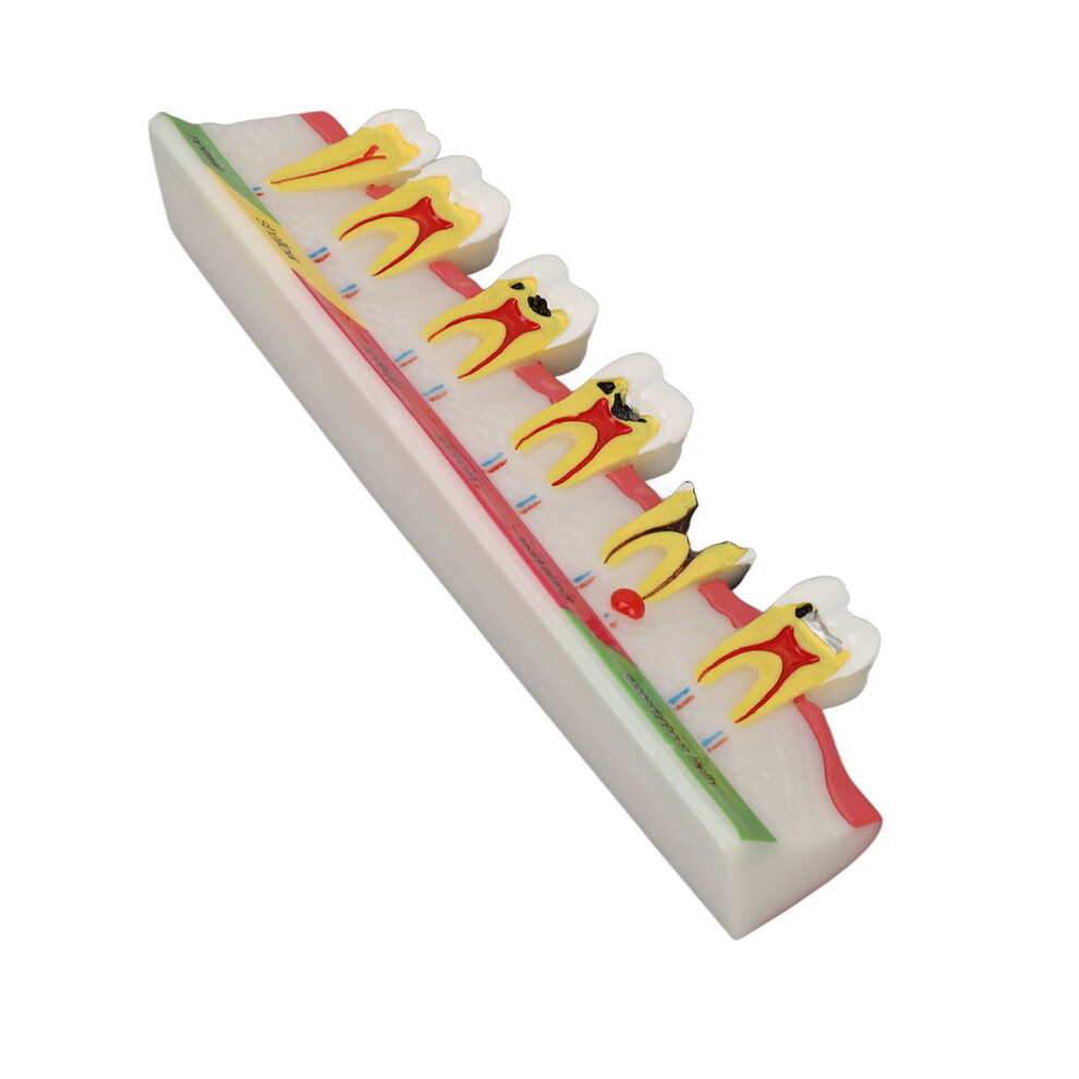 Dental Caries Model 6-Stage Resin Decayed Tooth Display for Dental Education