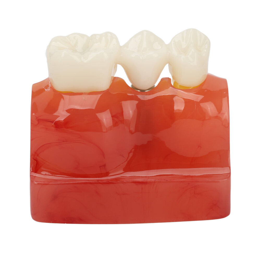 4X Dental Implant Crown Bridge Model for Patient Education, Resin