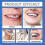 (2pcs) Denture Silicone Lining Silicone Fit Denture Silicone Reline Kit Denture Prosthesis Complete Denture Suitable For Silicone Dentures 5