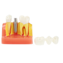 3 Pièces D'Implant Dents Amovibles