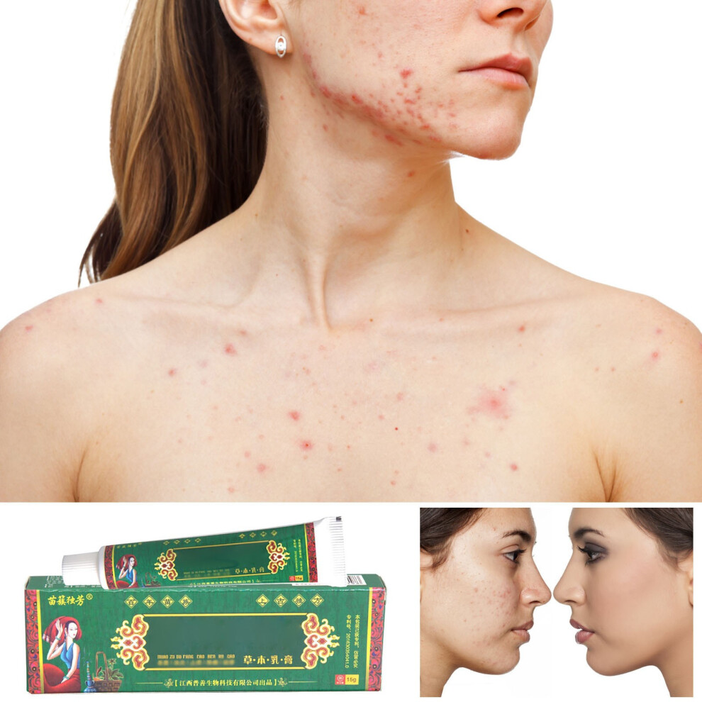 Green/Cream () Anti-Itch Herbal Itching Psoriasis Allergic Dermatitis Eczema