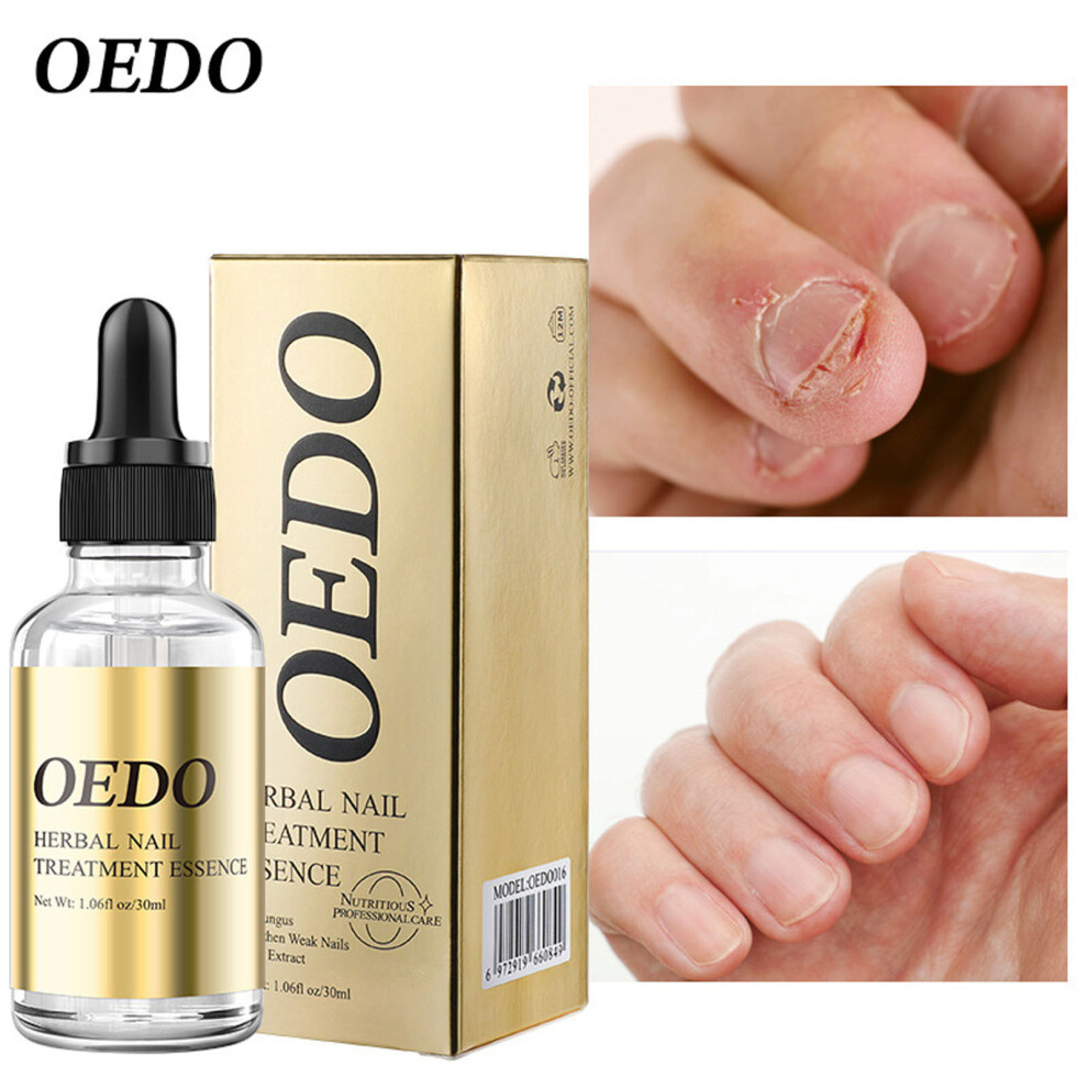 (Multicolor) Nail Liquid Nail And Foot Whitening Toe Nail Fungu Removal Herbal Nail Treatments Oil 30ML