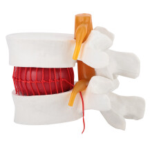 1:1.5 Lumbar Spine Herniation Medical Model