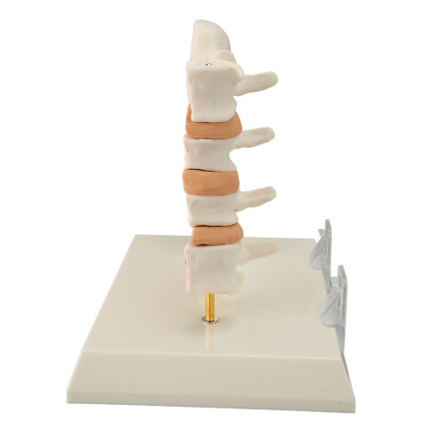 Osteoporose Wervelkolom Model voor Onderwijs 2