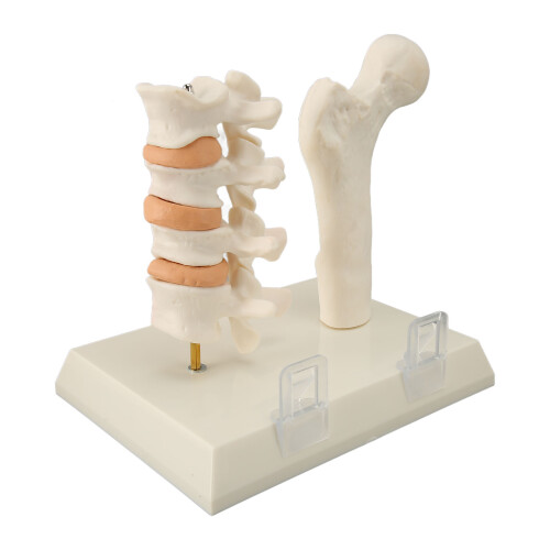 Osteoporose Wervelkolom Model voor Onderwijs 1