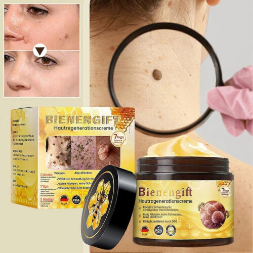 (2pcs)Bee-Venom Cream Fast Effective Wart Removing Cream for Body Face Use 1