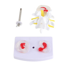 Anatomical Lumbar Disc Herniation Spine Training Model