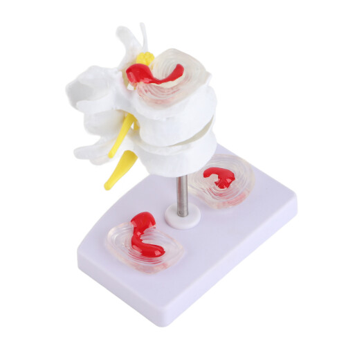 Anatomical Lumbar Disc Herniation Spine Training Model 1