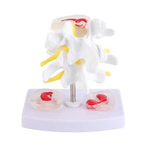 Anatomical Lumbar Disc Herniation Spine Training Model 2
