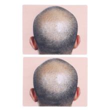 Man Bald Micropigmentation Practice Skin Silicone Hairline for Scalp