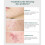 LANBENA Acne Gel 20g Spot Treatment 5