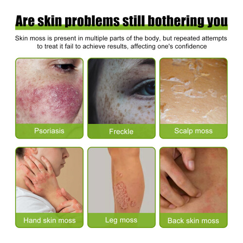 OUHOE Psoriasis Relief Cream 30g