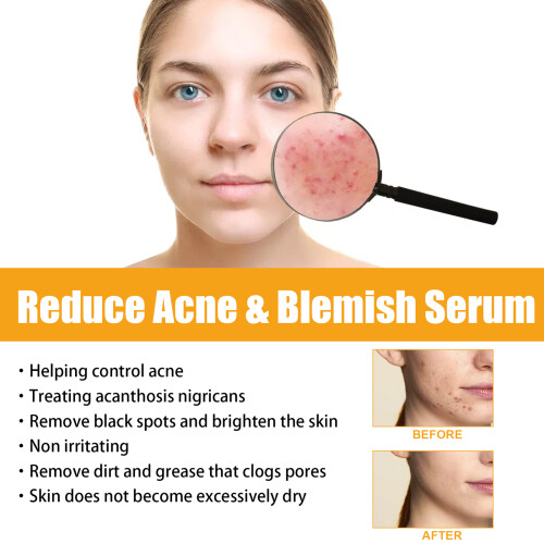 Jaysuing Anti-acne & Pimple Serum 2