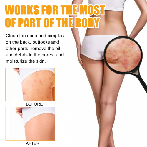 Jaysuing Anti-acne & Pimple Serum 1