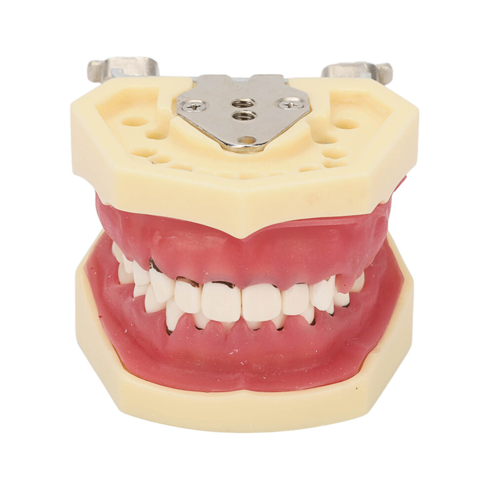 Periodontal Disease Teeth Resin Model for Teaching Study