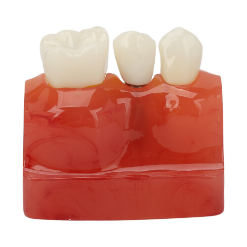 Modelo dentale impianto 4x corona ponte
