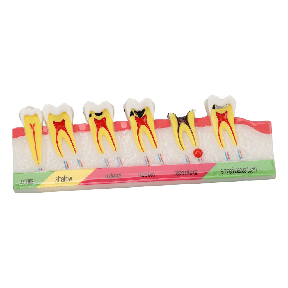 Dental Caries Model 6 Stages Resin Decayed Tooth Display