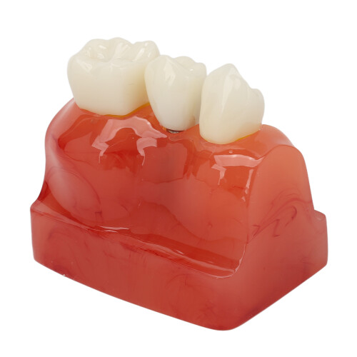 Modelo dentale impianto 4x corona ponte 2