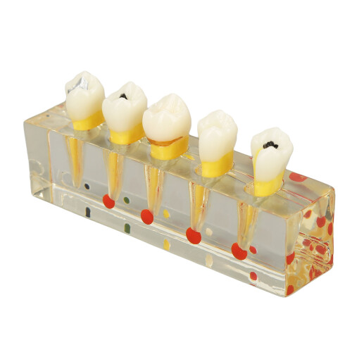 Modello dentale trasparente impianto carie 2