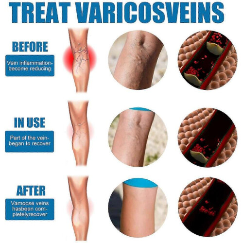 (1pcs) varicose vein massage spray 1 piece 2