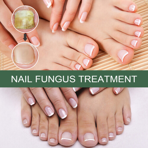 EELHOE 30ml Nagelzwambehandeling