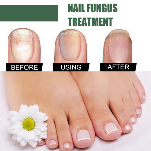 EELHOE 30ml Nagelzwambehandeling 1