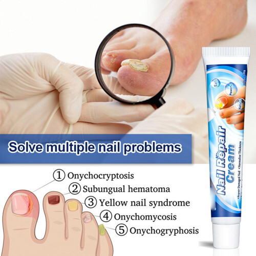 Nail Fungus Removal Cream 2