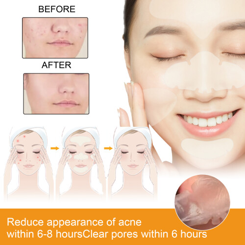 EELHOE Hydrocolloid Acne Pimple Patch 5PCS/Box Portable 2