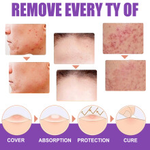 EELHOE 30ML Skin Tag Remover Wart Liquid for Neck Facial Axillary