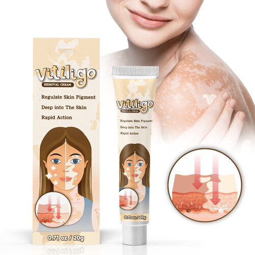 20g White Spot Vitiligo Herbal Ointment