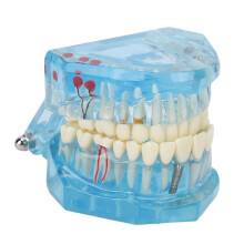 Klares abnehmbares Zahnmodell in Blau, transparent, Lehrzwecke