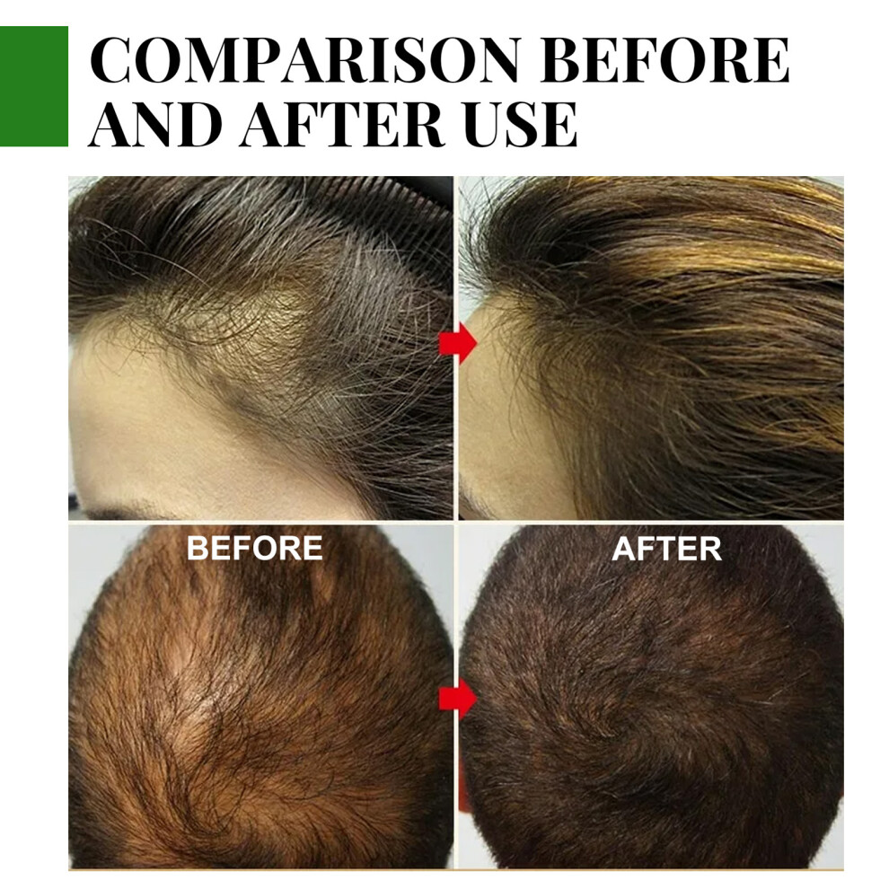 EELHOE Rosemary Hair Growth Essential Oil Prevent Hair Loss
