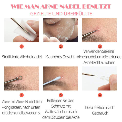 5x Roestvrij Staal Blackhead Extractor 1