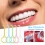 Orthodontisch uitneemtang helder plastic 2