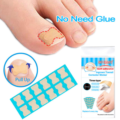 Ingroeiende Teennagel Corrector Stickers Blauw
