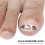 Correttore Unghie Incorporate Piedi 3