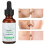 30ml Teebaumöl Serum Ölregulierend Poren Verkleinernd 5
