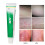 Psoriasis & Eczema Treatment Cream 4