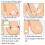 8-delig Ingroeiende Teennagel Correctie Set 5