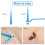 Skin Tag Remover Set Rubber Bands Patches 4-8mm 3