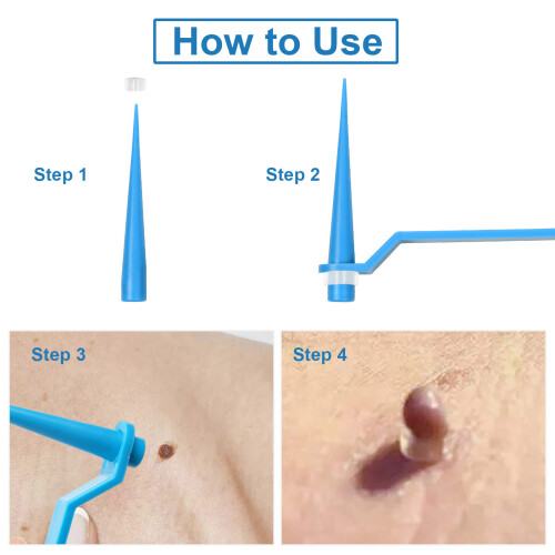 Skin Tag Remover Set Rubber Bands Patches 4-8mm 2