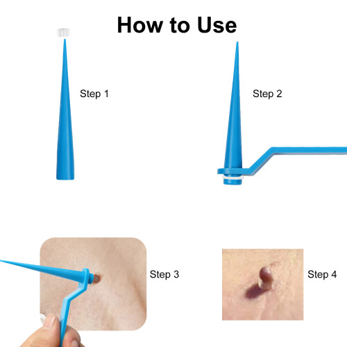 2-in-1 Skin Tag Remover Set Rubber Bands 2-8mm 1