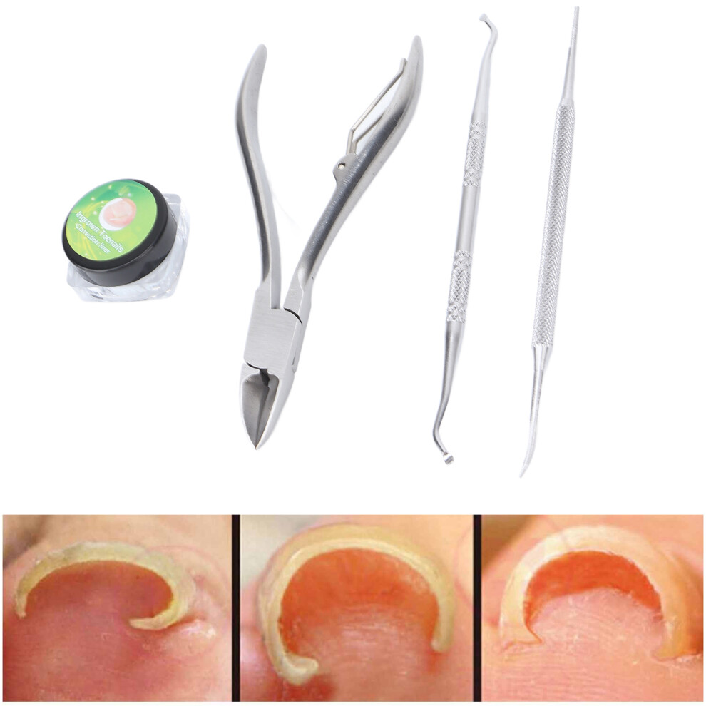 Ingrown Toenail Correction Kit 4pcs Strips File & Clippers for Toenail Care