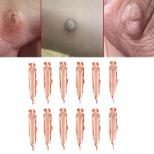 Safe Copper Skin Tag Removal Clips – 12pcs, 2.7cm, Face & Body
