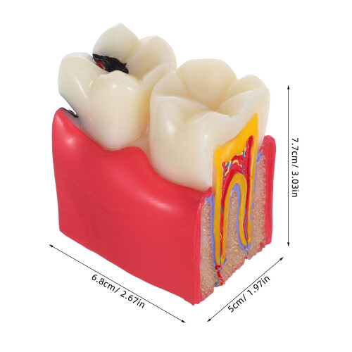 Didáctico De Con Caries Y Podrido Para Enseñanza 1