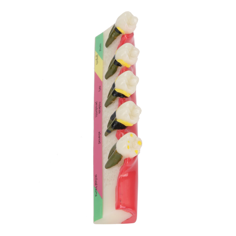 Dental Periodontal Disease Model Tooth Study Teaching Resin Demo for Dental Schools