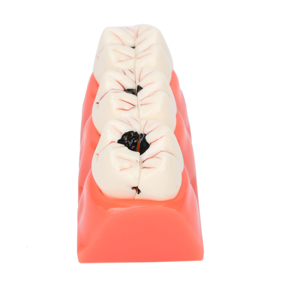 Tooth Decay Demonstration Model - Removable Teeth Dental Educational Tool