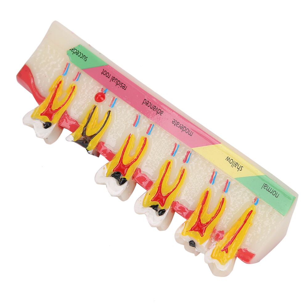 Portable Dental Caries Model for Teaching and Demonstration