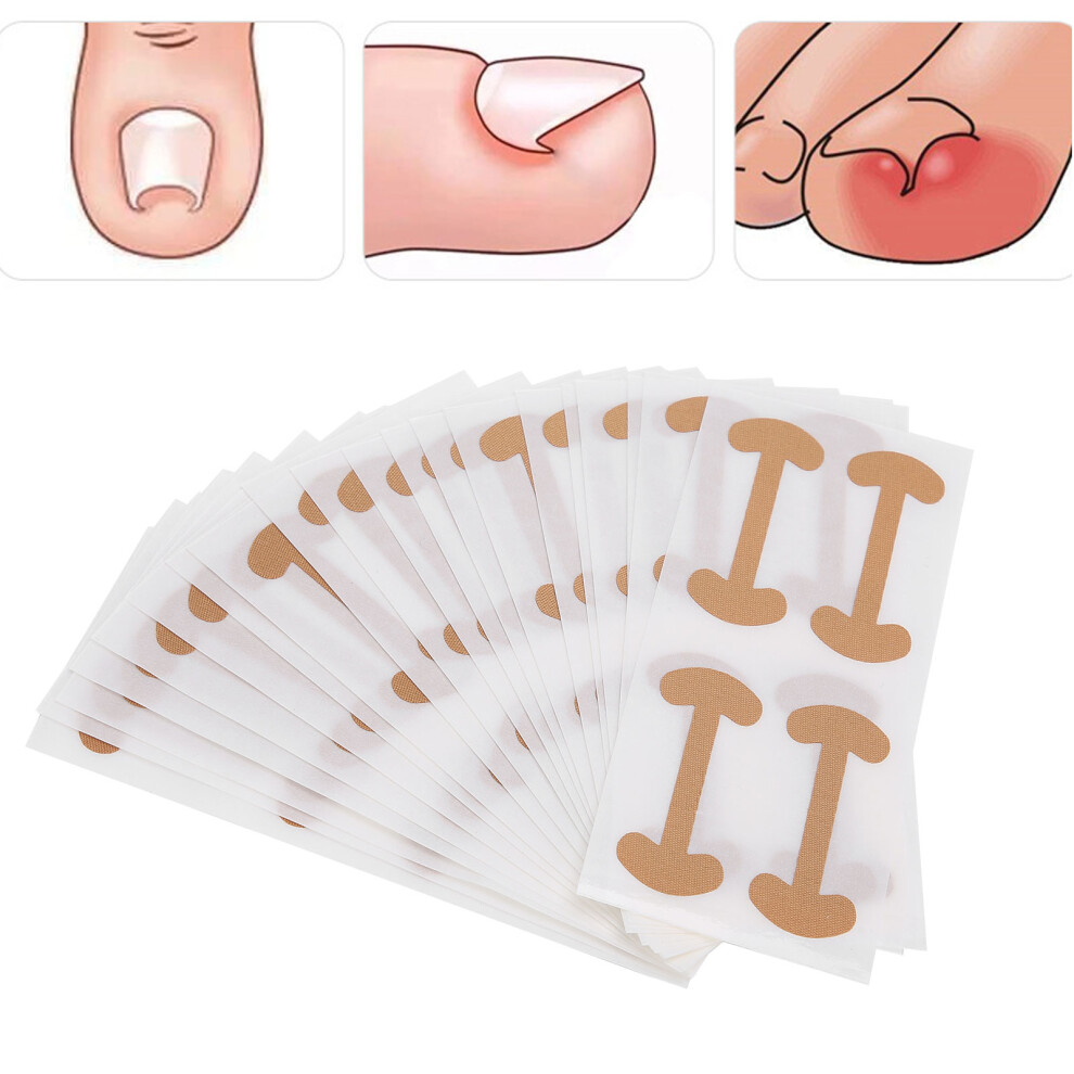 Ingrown Toenail Straightening Patch Adhesive Paronychia Nail Corrector Bandage
