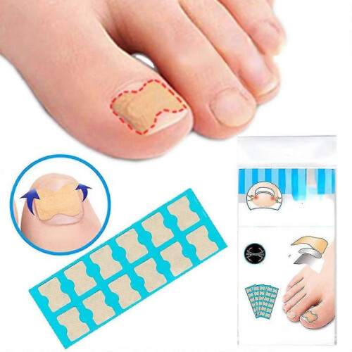 (72) Glue-free Ingrown Nail Paste Ingrown Nail Corrector Tool High Quality 2